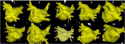 Safety and Efficacy Using the Second-Generation Cryoballoon in Patients With Atrial Fibrillation and a Common Ostium of Inferior Pulmonary Veins